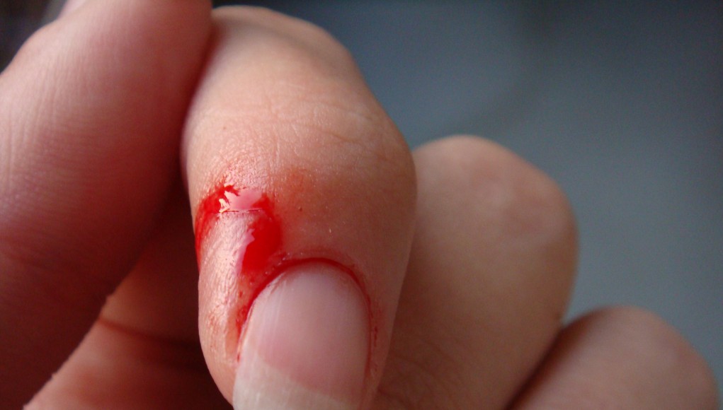 Finger Cut